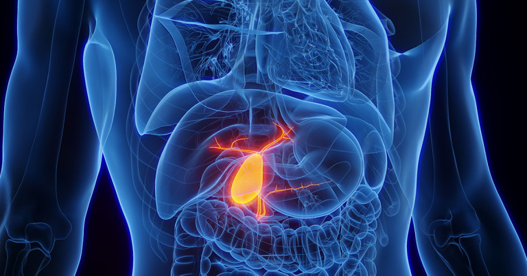 Colelitiasi (Calcoli biliari)