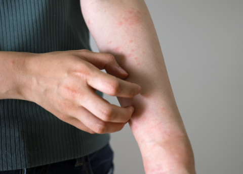 Quando un’allergia alimentare causa orticaria