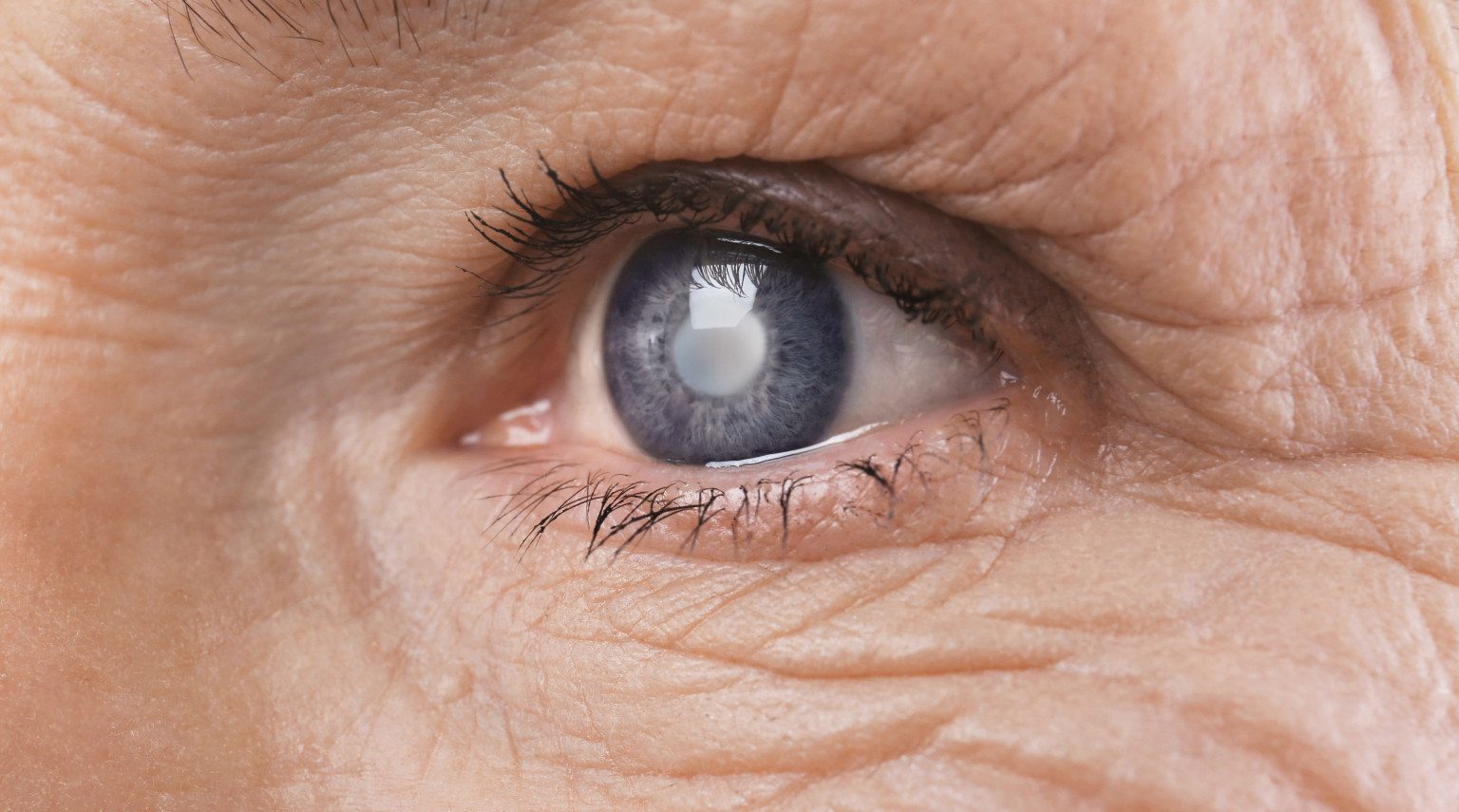 Intervento per la cataratta: quanto dura, come si svolge e tempi di recupero