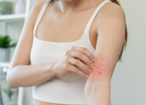 I rimedi per la dermatite da sudore