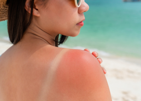 Cosa mettere sulle scottature da sole?