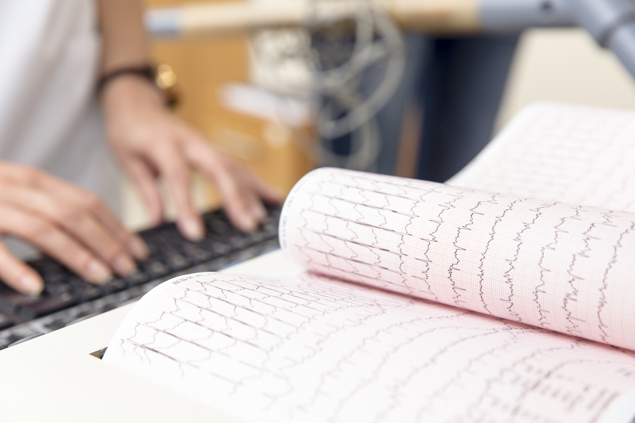 FIBRILLAZIONE ATRIALE