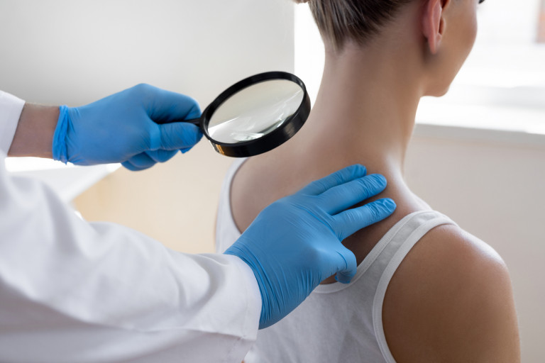 Lupus eritematoso sistemico