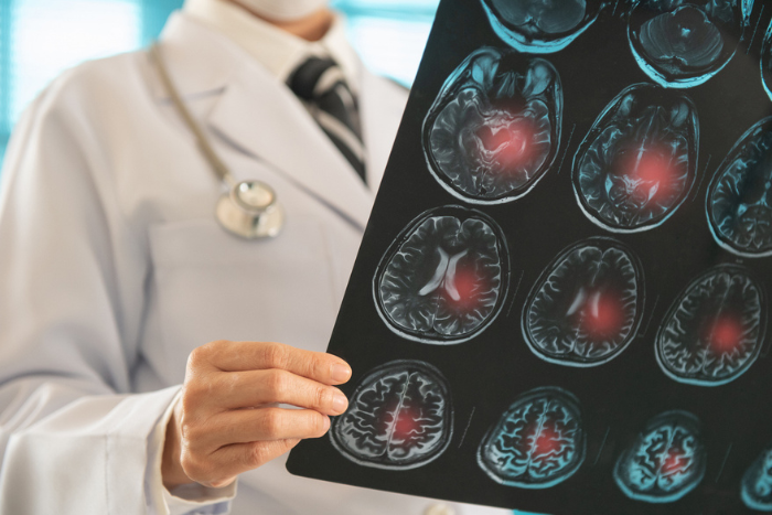 Riabilitazione post-ictus: quali esercizi per il recupero