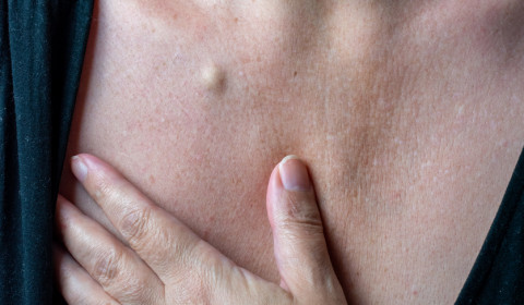 Asportazione di cisti sebacea