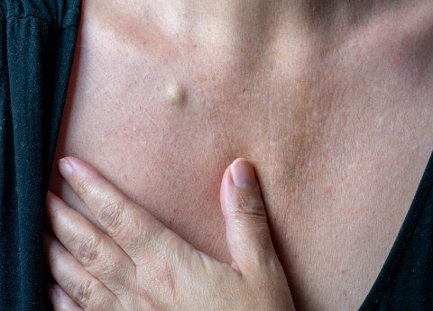 Asportazione di cisti sebacea