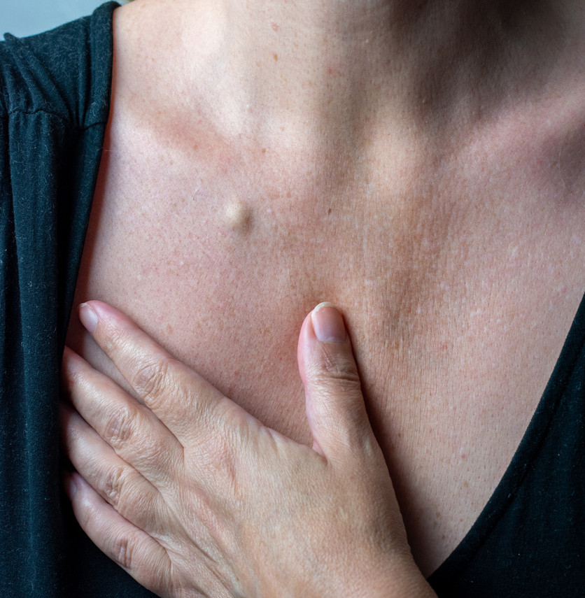 Asportazione di cisti sebacea